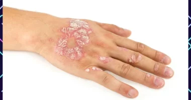 Psoriasis Treatment Improved: A Review of Etiopathogenesis and Treatment