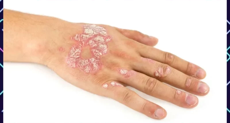 Psoriasis Treatment Improved: A Review of Etiopathogenesis and Treatment