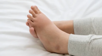 5 Conditions That Cause Swelling In The Legs And Feet
