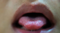 Are Tongue Ulcers Contagious And Harmful?
