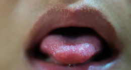 Are Tongue Ulcers Contagious And Harmful?