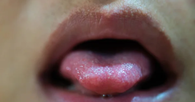 Are Tongue Ulcers Contagious And Harmful?