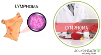 Final Stages of Mantle Cell Lymphoma: Prognosis, Treatment Options, and Support