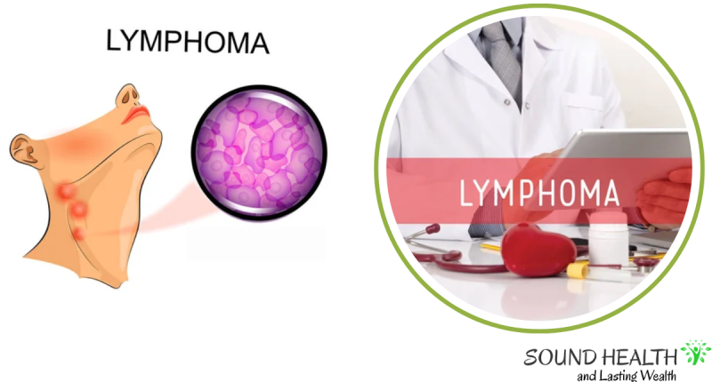 Final Stages of Mantle Cell Lymphoma: Prognosis, Treatment Options, and Support