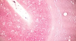 Placental GBS DNA Linke to Higher Neonatal Unit Admissions