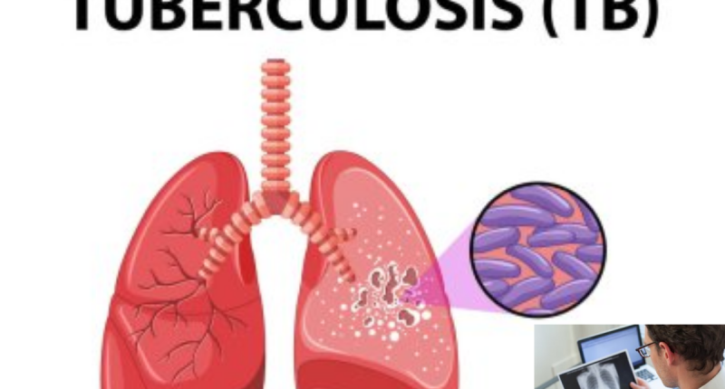 What Is The First Sign Of Tuberculosis TB? Types, Causes, Transmission and Prevention