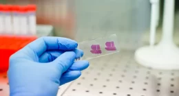 Early detection of hepatocellular carcinoma could be revolutionized by advanced AI techniques