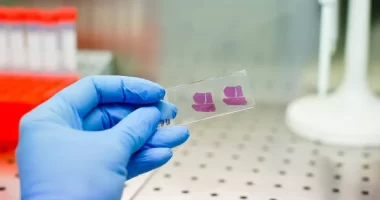 Early detection of hepatocellular carcinoma could be revolutionized by advanced AI techniques