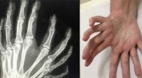 What Is mirror hand syndrome? Causes, signs and Implication