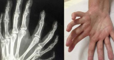What Is mirror hand syndrome? Causes, signs and Implication