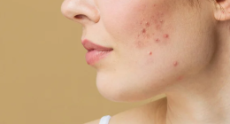 Where does the pus go if you don't pop a pimple?