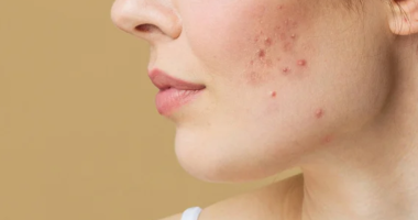 Where does the pus go if you don't pop a pimple?