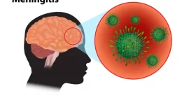 Bacterial Meningitis in Children: Lifelong Disability Looms Despite Curable Infection