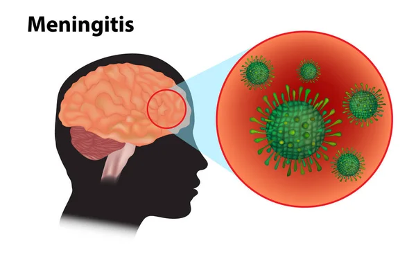 Bacterial Meningitis in Children: Lifelong Disability Looms Despite Curable Infection