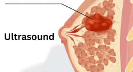 Intraductal papilloma cancer: How does it Happen?