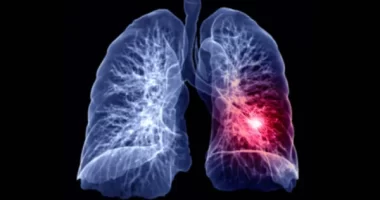 Non-Smokers' Lung Cancer Now a Top Five Global Cancer Killer