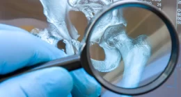 New Gene Mutation Linked to Rare Skeletal Disorder: Researchers at McGill Unravel the Mystery