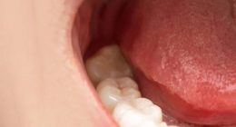 Does everyone have to get their wisdom teeth removed?