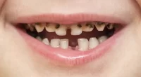 Can serum vitamin D cause dental caries or molar incisor hypomineralisation in children?