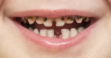 Can serum vitamin D cause dental caries or molar incisor hypomineralisation in children?