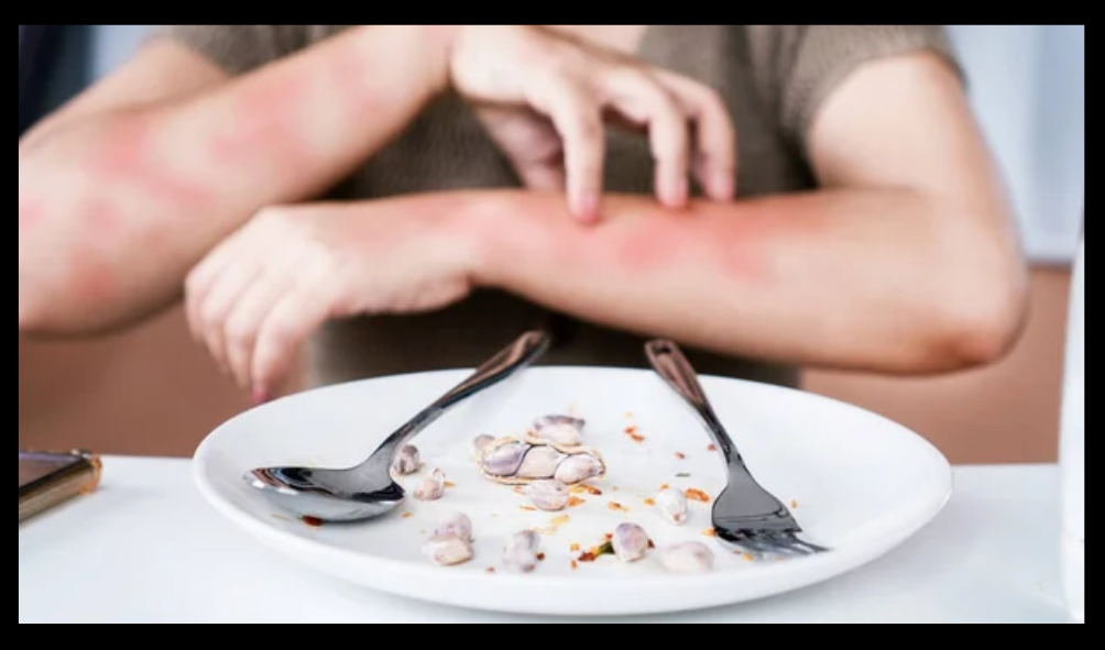 Anaphylaxis vs Allergic Reaction