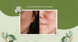 Melasma Skin Condition: What Is the Best Treatment?