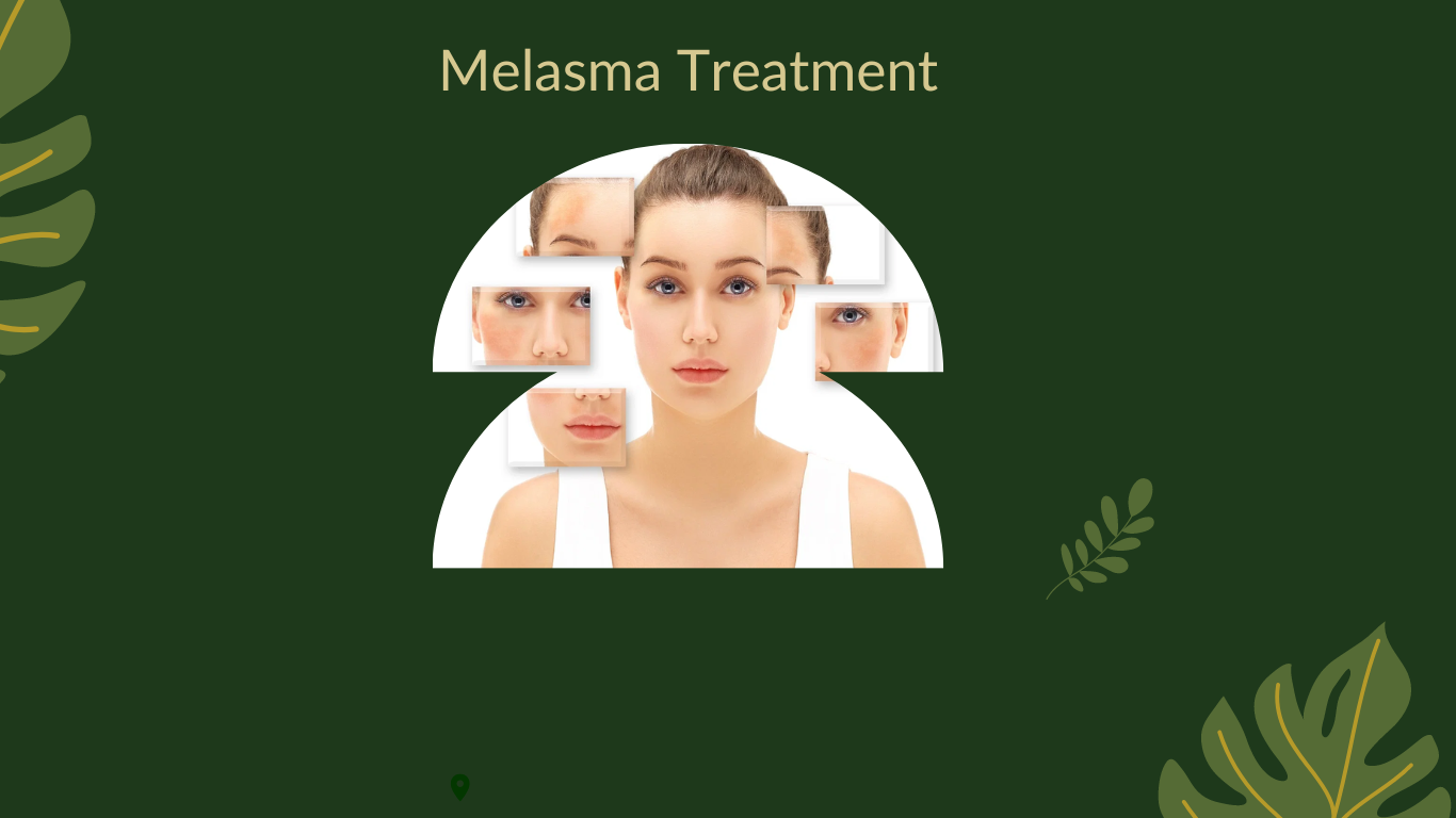 Melasma Treatment
