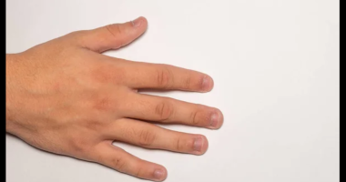 Nail Changes: What Your Fingernails Reveal About Your Health