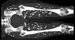 Undercooked Pork Leads to Horrifying Parasitic Infection, Doctor Warns