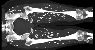 Undercooked Pork Leads to Horrifying Parasitic Infection, Doctor Warns