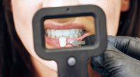 Veneer Techs vs. Licensed Dentists: Protect Your Smile Safely