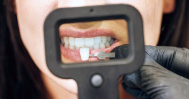 Veneer Techs vs. Licensed Dentists: Protect Your Smile Safely