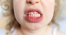 Secrets to Healthy Teeth: Preventing 'Bad' Teeth in Children