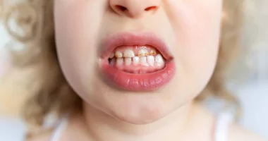 Secrets to Healthy Teeth: Preventing 'Bad' Teeth in Children