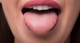 Tongue Sores in Pregnancy: Causes, Relief, and Prevention Tips