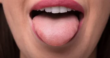 Tongue Sores in Pregnancy: Causes, Relief, and Prevention Tips