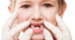 Baby Teeth Not Falling Out? Here’s What You Need to Know