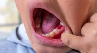 Preventing Dental Injuries: What to Do When Teeth Are Knocked Out or Cracked