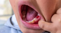 Preventing Dental Injuries: What to Do When Teeth Are Knocked Out or Cracked