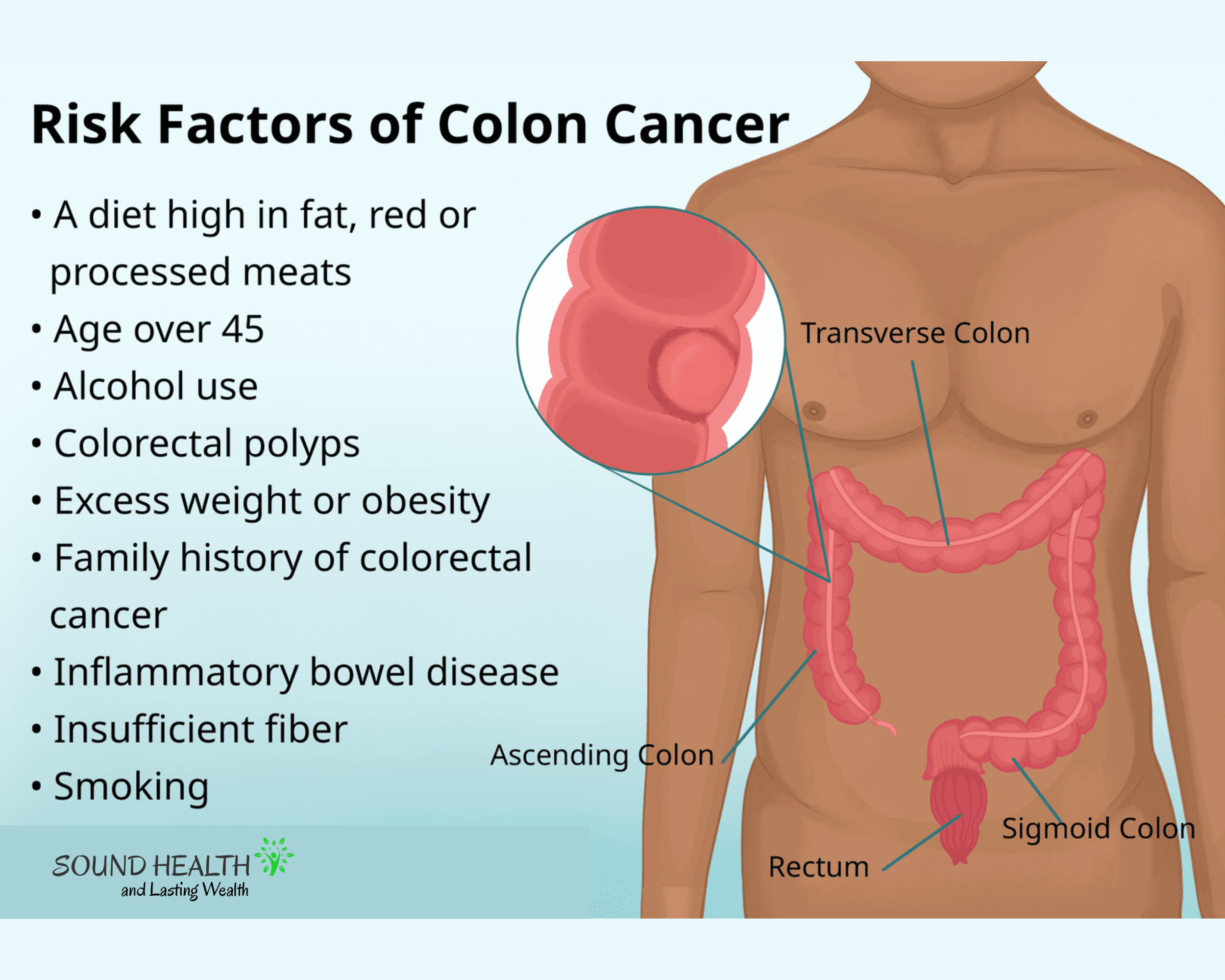 Colorectal Cancer