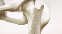 5 Natural Tips to Boost Bone Density and Prevent Osteoporosis