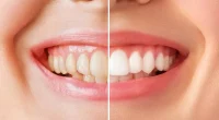 10 Effective Ways to Restore the Brightness of Older Teeth
