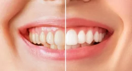 10 Effective Ways to Restore the Brightness of Older Teeth
