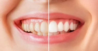 10 Effective Ways to Restore the Brightness of Older Teeth