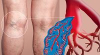 How to Identify DVT Symptoms and Reduce Blood Clot Risk