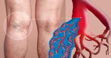 How to Identify DVT Symptoms and Reduce Blood Clot Risk
