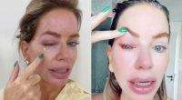Real Housewives' Caroline Stanbury Battles Severe Eye Infection: Swelling, Pain, and Recovery Updates