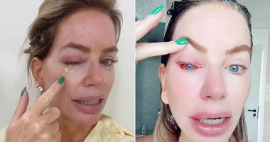 Real Housewives' Caroline Stanbury Battles Severe Eye Infection: Swelling, Pain, and Recovery Updates