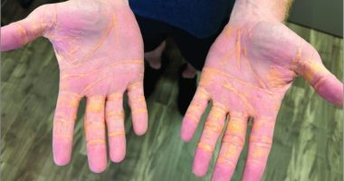 Extreme Carnivore Diet Led to Lesions: Man Develops "Cholesterol Hands"