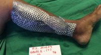 Fish Skin Bandages - Could fish scales hold the key to rapid wound recovery?
